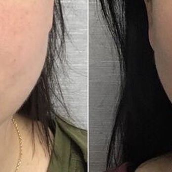 Zenn Plastic Surgery - Before and after pics of lip filler and jaw filler - Cosmetic Surgeons Near Me - Raleigh, North Carolina