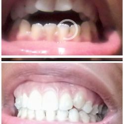 Smiles 4 Life Orthodontics - Before (top) after (bottom) open bite. Invisalign