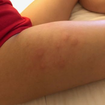 Woodbine Hotel And Suites - Pattern looks like bed bugs but its also really inflamed and itches like hell - Hotels Near Me - Toronto, Ontario Woodbine Hotel And Suites - Pattern looks like bed bugs but its also really inflamed and itches like hell - Hotels Near Me - Toronto, Ontario
