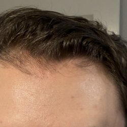 Bosley Hair Restoration & Transplant - 2 years post 1st transplant