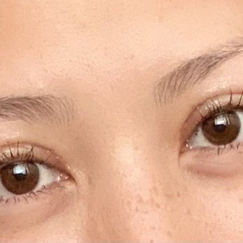 Cheng Plastic Surgery - Post-op 2 weeks - Cosmetic Surgeons Near Me - Saratoga, California