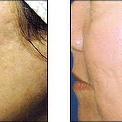 Advanced Dermatology - Fraxel Laser Treatment