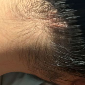 PSY Spa USA - Inflammation - Skin Care Near Me - San Leandro, California