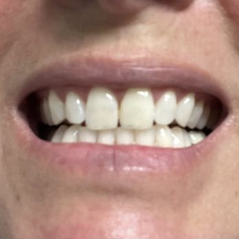 Ryan Duval - Loop 101 Endodontics - After - Endodontists Near Me - Scottsdale, Arizona Ryan Duval - Loop 101 Endodontics - After - Endodontists Near Me - Scottsdale, Arizona