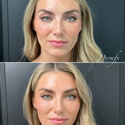 DermFx - Facial balancing with filler