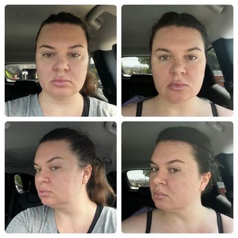 Flawless Skin Center - Morpheus8 - Laser Hair Removal Near Me - Sherman Oaks, California Flawless Skin Center - Morpheus8 - Laser Hair Removal Near Me - Sherman Oaks, California