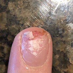Broken nail