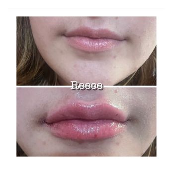Everyday Bombshell Aesthetics - 0.5cc's Lip Filler - Medical Spas Near Me - Longview, Texas