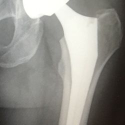 Orthopedic Associates - My new left hip hardware!!! It moves so incredibly smooth!! It didn't know it could be so good feeling! Thanks Dr Caufield!!!!