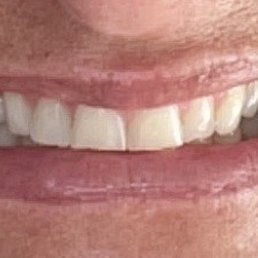 My New Smile!!!