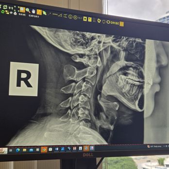 Ho'ola Chiropractic - X-ray Image of My Cervical Joints - Chiropractors Near Me - Honolulu, Hawaii