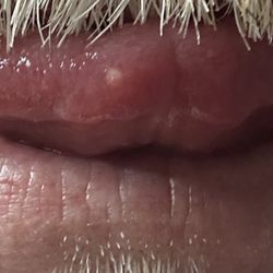 Dentistry In Oro Valley - My tongue is killing me!
