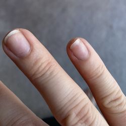 Collegeville Nails - Overfiled nails and nail trauma