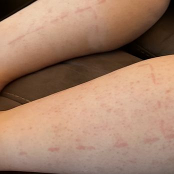 Tri Valley Plastic Surgery - Marks on my two legs showing the quadrants. - Medical Spas Near Me - Dublin, California