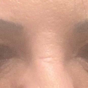 Bruce  Moskowitz, MD - Upper before - Plastic Surgeons Near Me - New York, New York