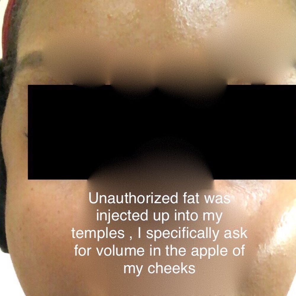 Unauthorized fat injected into my temples Unauthorized fat injected into my temples