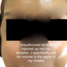 Unauthorized fat injected into my temples Unauthorized fat injected into my temples