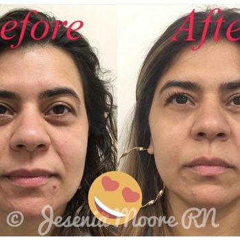 Nurse Jes - Went from tired and droopy eye to refreshed and relaxed - Medical Spas Near Me - New York, New York Nurse Jes - Went from tired and droopy eye to refreshed and relaxed - Medical Spas Near Me - New York, New York