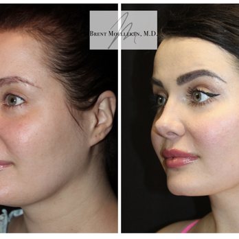 Moelleken Plastic Surgery - Reconstructive Fat transfer to lips and nasolabial folds, pinched nose correction, lip lift, neck lipo & necklace, hairline reshaping - Cosmetic Surgeons Near Me - Beverly Hills, California Moelleken Plastic Surgery - Reconstructive Fat transfer to lips and nasolabial folds, pinched nose correction, lip lift, neck lipo & necklace, hairline reshaping - Cosmetic Surgeons Near Me - Beverly Hills, California