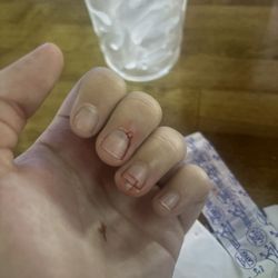 Snickers Bar & Grill - Crushed finger :(