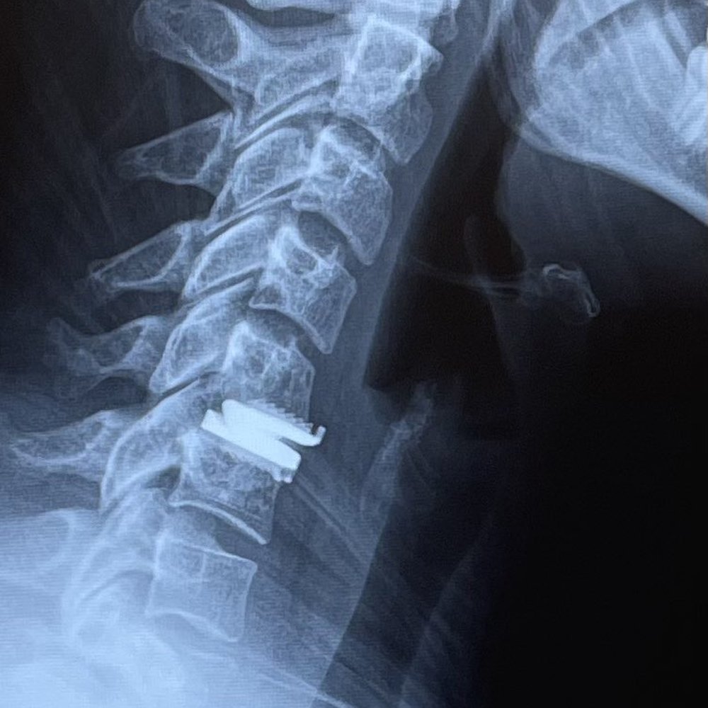 Sean Keem, MD - Kyphosis post-surgery - Orthopedists Near Me - Seattle, Washington