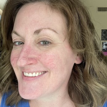 NWME Aesthetics - Before any treatments - Skin Care Near Me - Carrollton, Texas
