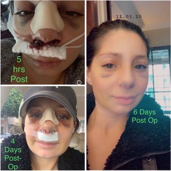 Robert Kotler, MD FACS - Post op - Cosmetic Surgeons Near Me - Beverly Hills, California Robert Kotler, MD FACS - Post op - Cosmetic Surgeons Near Me - Beverly Hills, California