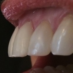 Sleep Healthy PA - Bucked, protruding chair side made temporaries that were to be used  to make molds for veneers.