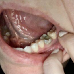 Black, uncrowned, failed root canal done by this dentist Black, uncrowned, failed root canal done by this dentist