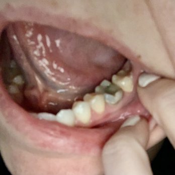 Lynn Mojica, DMD - Black, uncrowned, failed root canal done by this dentist - General Dentistry Near Me - San Francisco, California Lynn Mojica, DMD - Black, uncrowned, failed root canal done by this dentist - General Dentistry Near Me - San Francisco, California