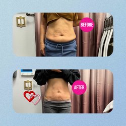 Slim Reveal Body Sculpting - Cavitation and Radio frequency