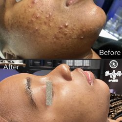 Simply Me Skin Care & Med Spa - Behold Results from Our Amazing Acne Program by Face Reality!