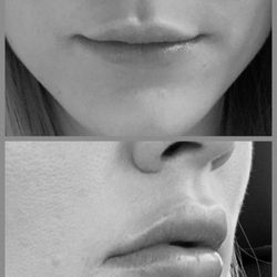 Innovative Aesthetics MD - Beverly Hills Lips™ signature treatment using a combination of threads, fillers and Hydraluxe to achieve a perfect pout.