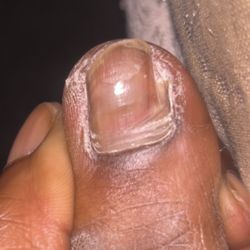Over shaved nail till it touched skin