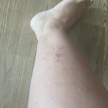 Ocean Pointe Suites at Key Largo - Bites on 1 leg to start with. Plenty more on other parts of our bodies - Hotels Near Me - Key Largo, Florida Ocean Pointe Suites at Key Largo - Bites on 1 leg to start with. Plenty more on other parts of our bodies - Hotels Near Me - Key Largo, Florida
