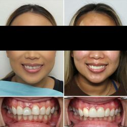 Bidwell Dental - After this smile transformation, this patient can now show her teeth with confidence :)