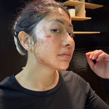 Pore Decisions Med Spa - Post Micro-needling/ PRP - Medical Spas Near Me - San Jose, California