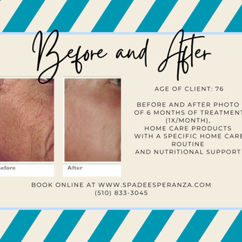 Spa De Esperanza - Before and After Photo
(The Aging Skin) - Day Spas Near Me - Richmond, California Spa De Esperanza - Before and After Photo
(The Aging Skin) - Day Spas Near Me - Richmond, California
