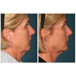 Onyx Body & Wellness Spa - Ultherapy Before & After Picture