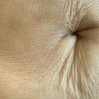 AirSculpt - Beverly Hills - Elite Body results showing the awlful way my skin looks : - Cosmetic Surgeons Near Me - Beverly Hills, California AirSculpt - Beverly Hills - Elite Body results showing the awlful way my skin looks : - Cosmetic Surgeons Near Me - Beverly Hills, California