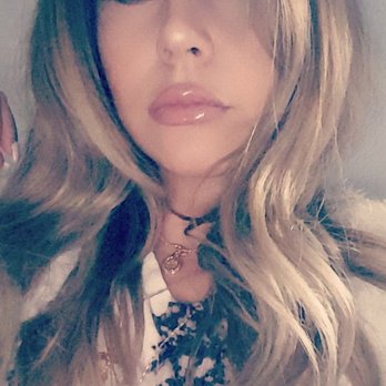 Lucent Cosmetics - 2nd day after 1cc of Juvederm ultra plus - Medical Spas Near Me - Glendora, California