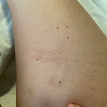 Sweet Peach Wax & Sugaring Studio - This pic was taken one week exactly after my wax.. is it now a scar and I'm working on brightening it. See previous pic for reference. - Sugaring Near Me - Atlanta, Georgia Sweet Peach Wax & Sugaring Studio - This pic was taken one week exactly after my wax.. is it now a scar and I'm working on brightening it. See previous pic for reference. - Sugaring Near Me - Atlanta, Georgia