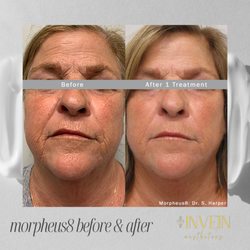 Invein Aesthetics - Morpheus8 is a cutting-edge skin rejuvenation treatment to enhance your skin's youthfulness and vitality.