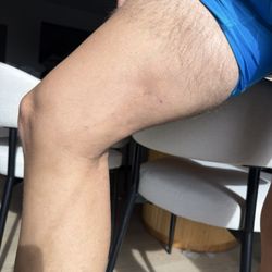 Vein Specialty Medical Clinic - Inside of the leg post surgery