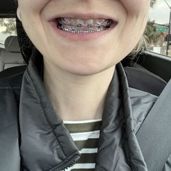 Welmerink & Utter Orthodontics - Braces after adjustment