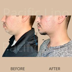 Pacific Lipo - Los Angeles - Chin lipo with Jplasma skin tightening