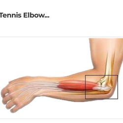 Daniel Fung Chiropractic - Lateral epicondylitis aka tennis elbow. My specialty!