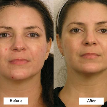 Elev8skin - 1 session of 60 minutes Microcurrent facial - Skin Care Near Me - San Anselmo, California Elev8skin - 1 session of 60 minutes Microcurrent facial - Skin Care Near Me - San Anselmo, California