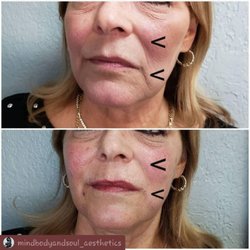 Chinitas Beauty And Eyebrow Spa by Dailyn Gonzalez - Pdo threads and lip filler