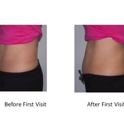 7e Fit Spa - After 1 treatment